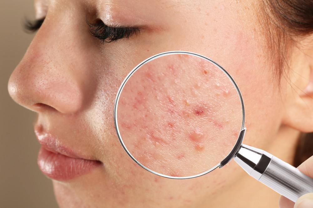 5 things that are triggering your acne